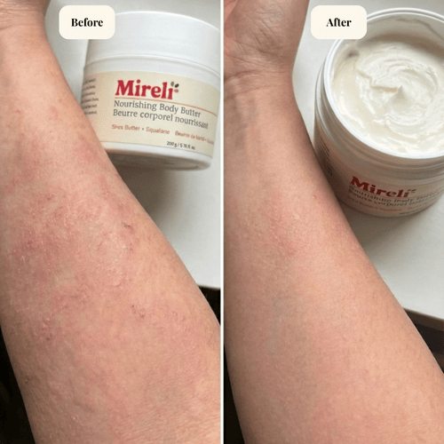 mireli naturals before and after comparison image for eczema