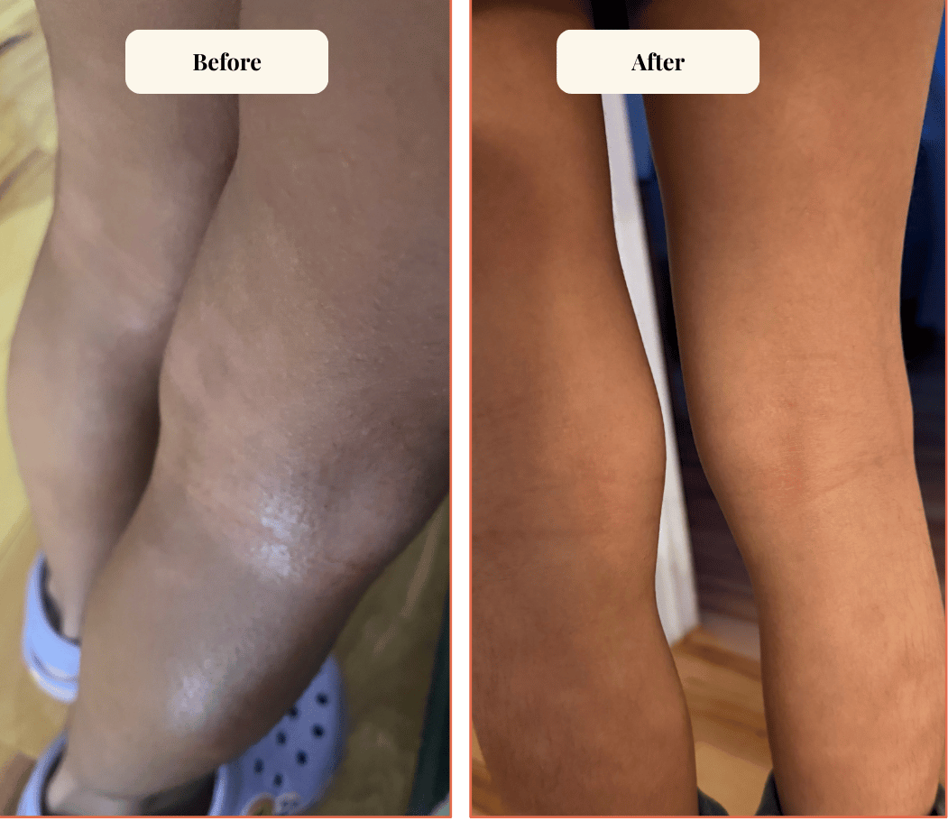 Before and after comparison of a person's leg with visible skin condition.