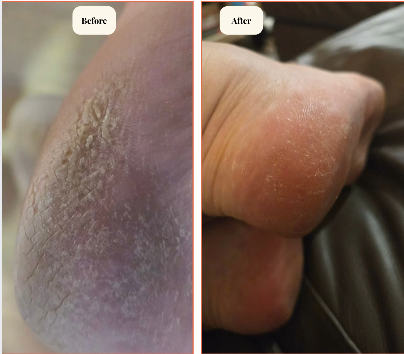 Before and after comparison of a foot with visible calluses.