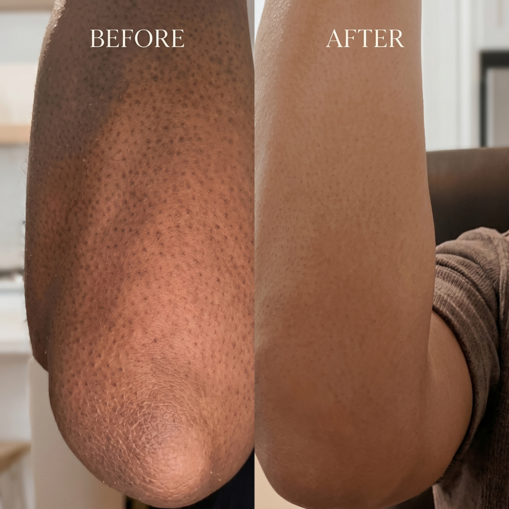 mireli_naturals_Before_and_after_comparison_of_a_skin_treatment_on_arm.