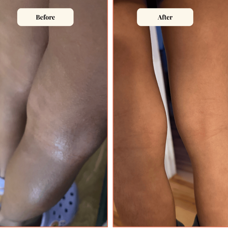 mireli naturals before and after image for dry feet with dark spots