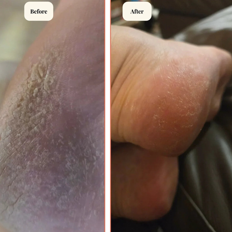 mireli naturals bidy butter before and after image real comparison for cracked feet